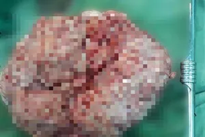 Khối u xơ gần 4kg cứ tưởng mang bầu 20 tuần