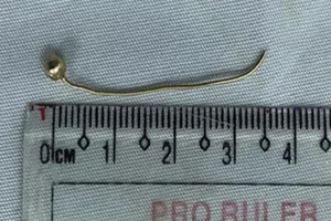 Bé 7 tháng rách thực quản do nuốt hoa tai bằng vàng