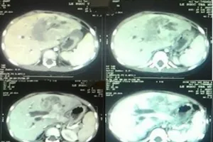 Kỳ lạ: Bác sĩ hy vọng khối u của bệnh nhi là u ác tính