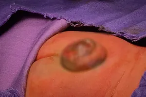 Hy hữu: Bé 2 ngày tuổi bị não úng thủy ở mông