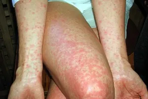 1 ca tử vong do bệnh sởi ở Hà Nội 