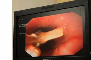 Xém chết vì hóc xương rồi ngồi đợi xương... tự tan