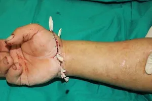 'Khắc nhập' bàn tay đứt lìa sau 3 giờ ướp đá lạnh 