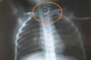 Cô giáo bất lực vì không có tiền chuyển viện cho con