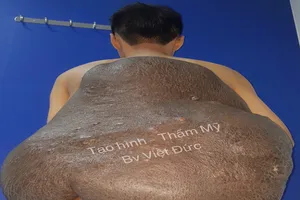 Kỳ lạ chàng trai mang 'mai rùa' nặng 15 kg suốt 26 năm