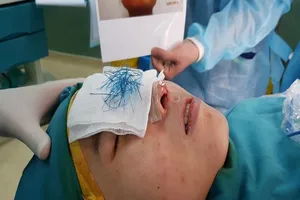 Mũi hoại tử xanh lè do dùng chỉ khâu da để nâng mũi