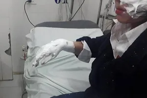 Nổ bóng bay galaxy, 3 sinh viên nhập viện vì bỏng nặng