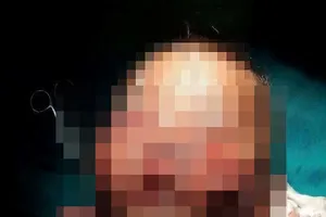 Bé 3 tuổi bị chó cắn tổn thương nghiêm trọng vùng mặt