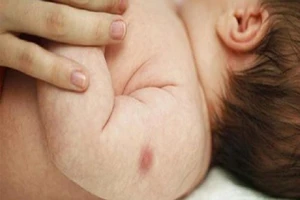 Đắp khoai tây, lòng trắng trứng gà giảm sưng tấy sau tiêm?