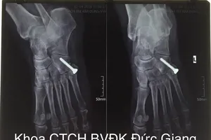 Mang 'bệnh lạ' suốt 20 năm sau cú ngã trẹo chân