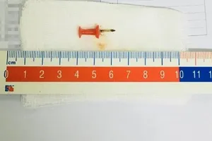 Chiếc ghim giấy nằm trong phế quản bé 2 tuổi