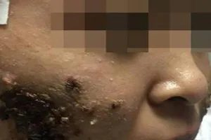 Kinh hoàng mặt biến thành mảng cơm cháy sau 1 tuần