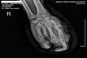 Bất cẩn, người đàn ông bị máy ép gạch nghiền nát bàn tay