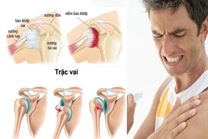 Lần đầu tiên thay khớp vai cứu thầy giáo bị u xương hiếm gặp