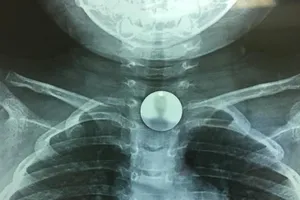 30 giây lấy đồng xu mắc kẹt trong họng bé gái 3 tuổi