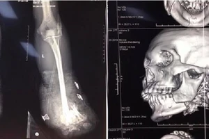 Nhiều bệnh nhân do pháo đến bệnh viện cho... kịp Tết 