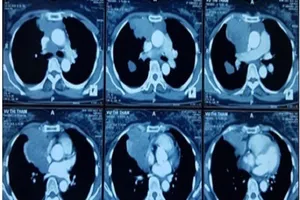 Xuyên Tết cứu bệnh nhân 2 lần cận kề cửa tử