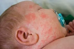 Dịch sởi bùng phát, lan rộng 43 tỉnh thành