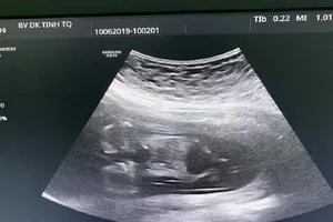 Hiếm gặp: Cặp song thai dính nhau chỉ có 1 trái tim