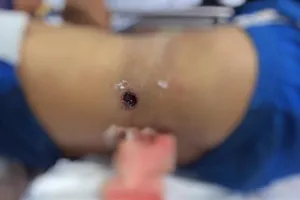 Đeo súng đi săn, súng cướp cò bắn thủng bụng nguy kịch