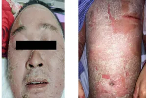 Mưng mủ, bong da khắp người vì 'vái nhầm' phương chữa bệnh