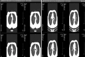 Hút thuốc lá 5 năm, chàng trai 23 tuổi bị tràn khí màng phổi