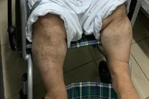 Lấy tĩnh mạch chân con cứu trái tim người bố lùn bẩm sinh