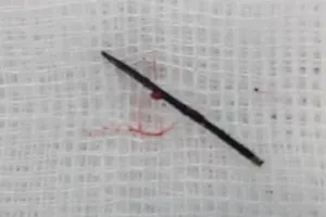 Sững sờ khi bác sĩ nói trong bụng con có cây kim dài 17 mm