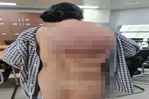 Giải phóng 'mai rùa' hơn 5 kg trên lưng người phụ nữ 53 tuổi