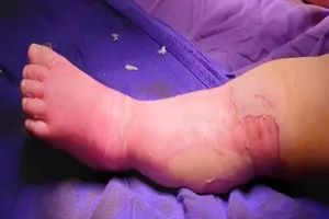 Bố mẹ đắp lá chữa bỏng nước sôi khiến bé 9 tháng tử vong