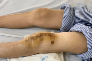 Thay khớp gối cho bệnh nhân lao khớp gối đầu tiên tại Việt Nam