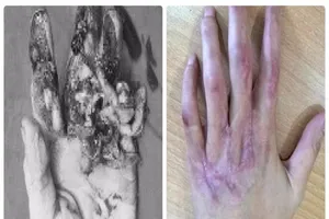 Hồi sinh kỳ diệu bàn tay dập nát cho cô gái trẻ