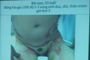 Bật lửa phát nổ trong túi quần, người đàn ông bỏng nặng