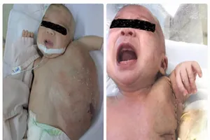 Bé sơ sinh mang khối bướu 'khủng' gần 1 kg