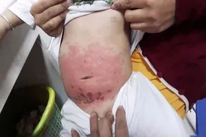 Mẹ dùng dầu gió bất cẩn, bé 14 tháng tuổi bị bỏng 