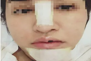 Silicon giả chất làm đầy: Chị em tiền mất, tật mang