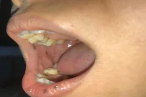 Phát hiện bệnh hiếm từ miệng có nhiều nốt sậm màu