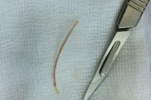 Tá hỏa không biết tăm, xương cá chui vào bụng lúc nào