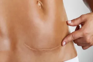 Bất ngờ vì thai làm tổ ở vết sẹo mổ cũ 