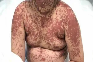 Bé gái nổi ban đỏ toàn thân sau khi uống thuốc hạ sốt