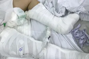 Bé gái 13 tuổi rơi từ lầu 3 chấn thương nặng