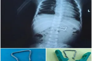 Bé trai 18 tháng suýt thủng ruột vì nuốt móc sắt kẹp áo