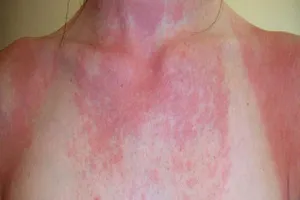 Nguyên nhân nữ bệnh nhân tử vong sau khi chích thuốc dị ứng