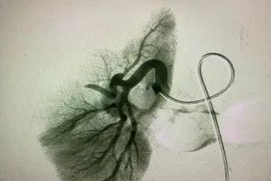 Hết lo cắt thận nhờ mũi tiêm thuốc nhỏ 