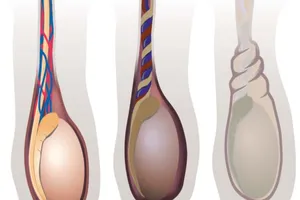 Bị cắt bỏ tinh hoàn do sưng đau bìu