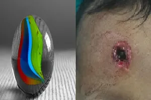 Bé trai bị đạn bị găm vào trán vì súng bắn chim cướp cò