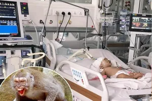 Kinh hoàng bé 14 tháng tuổi bị khỉ cắn rách đầu nguy kịch