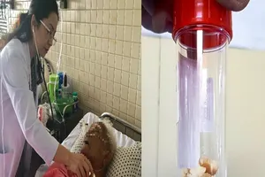 Hi hữu cụ ông gặp nguy vì hóc hạt mít 