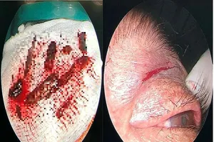 'Cân não' gắp 10 mảnh gỗ nằm sâu trong hốc mắt người đàn ông