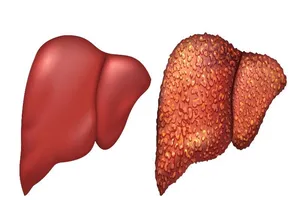 Giật mình 10 người mắc viêm gan B,C thì 9 người không hay biết